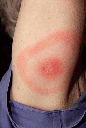 an image of circular red rash from lyme disease